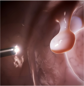colorectal cancer and targeted hyperthermia therapy - Sona Nanotech